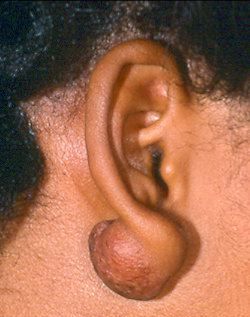 Home Remedies for keloids