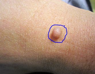 Home remedies for skin tags - you can remove skin tags naturally