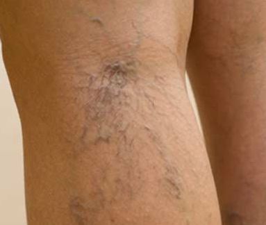 Home remedies for spider veins