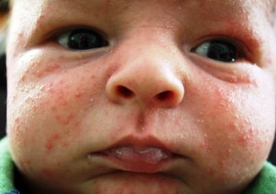 Home remedies for baby acne - you can treat and prevent pimple-like bumps on newborn's face naturally