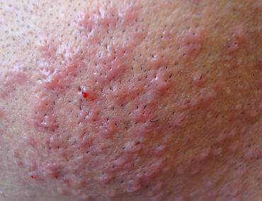 Home remedies for razor bumps