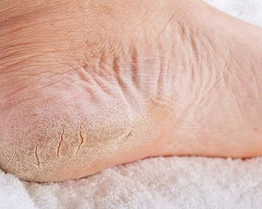 Home remedies for soft feet - make your feet softer naturally with these DIY treatments