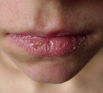 home remedies for chapped lips - natural treatments can help treat and soften severely dry and chapped lips