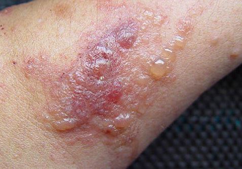 Home remedies for poison ivy rash