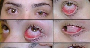 Home remedies for pink eye in adults