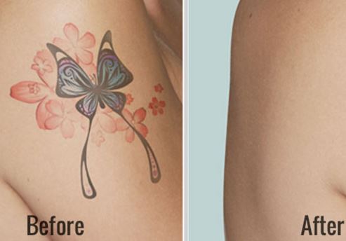 Home remedies for tattoo removal fast at home