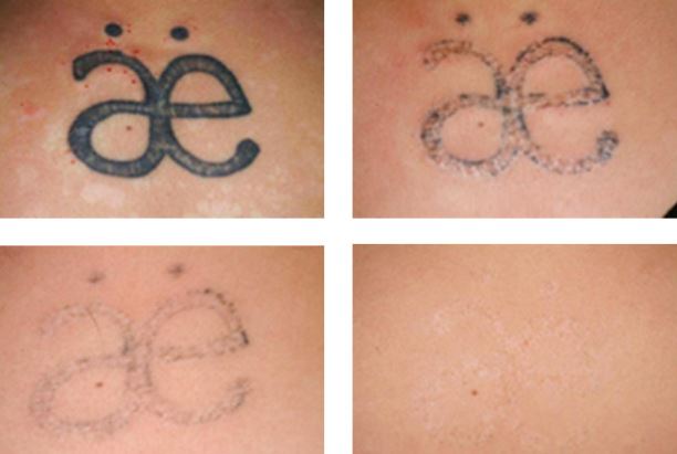 Salabration at home tattoo removal before and after pictures