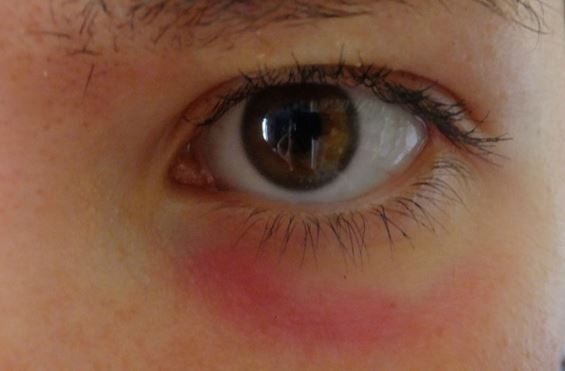 Redness Around Eyes Causes, Dry Red Circles on Eyes in ...