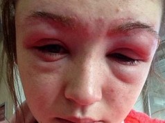 Swollen eyebrow area after reacting to eyebrow tint makeup