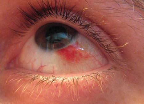 Pain Behind Left Eye | Med-Health.net