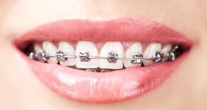 Attain white teeth with braces on