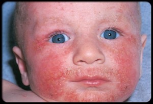 Eczema in babies