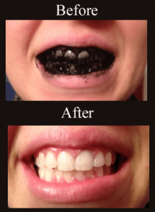 Activated charcoal teeth whitening during and after